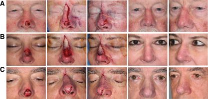 Skin Grafts Skin Cancer And Reconstructive Surgery Center