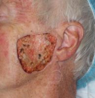 melanoma-in-situ-serial-excisions-mohs-excision-platysma-myocutaneous-flap-mapping-biopsy-orange-county-skin-cancer