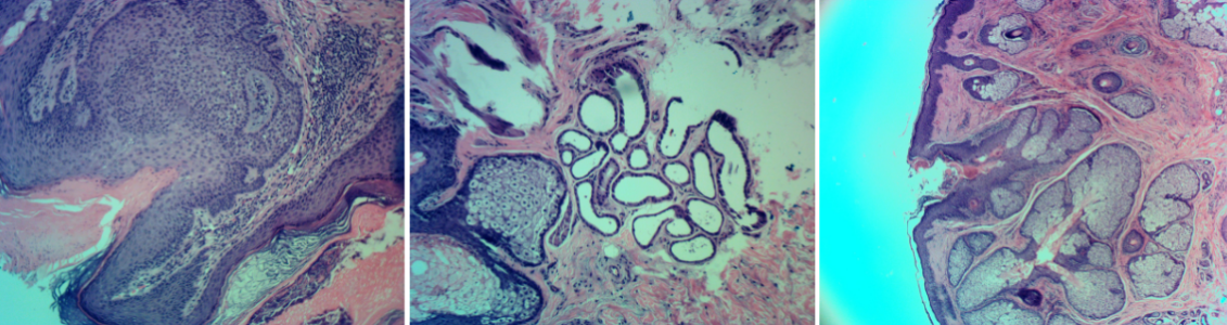 sebaceous-nevus-of-jadassohn-orange-county-skin-cancer-histomicrograph